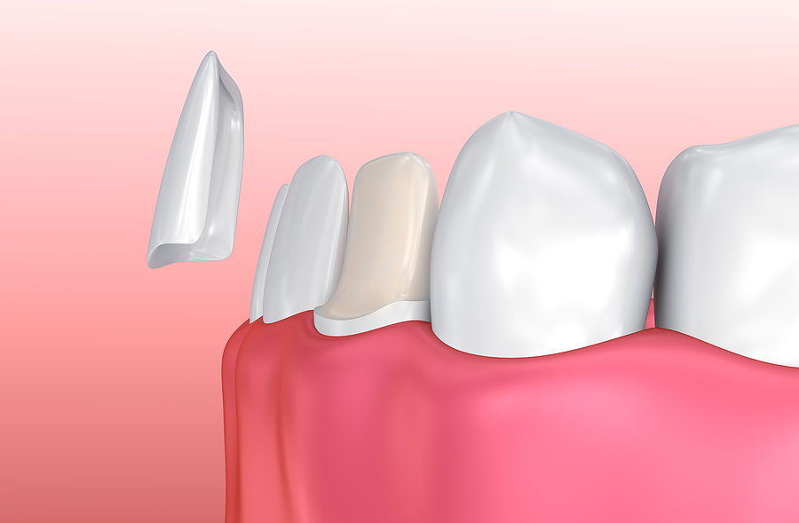 Your Veneers Have ‘Staying Power’ – if Cared for Properly