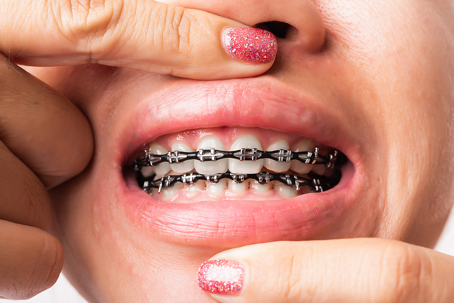 Lingual Braces Might be a Better Fit for Your Active Lifestyle
