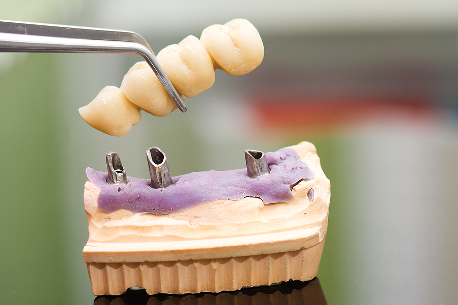 Don’t Let Smoking Increase Your Chances of Implant Failure
