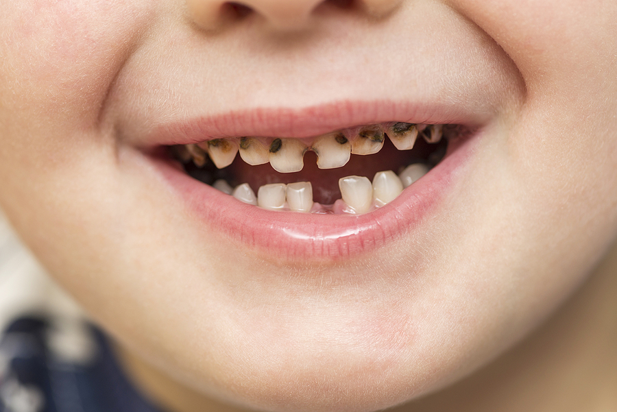 Here’s How to Avoid Dry Socket After Tooth Extraction Surgery