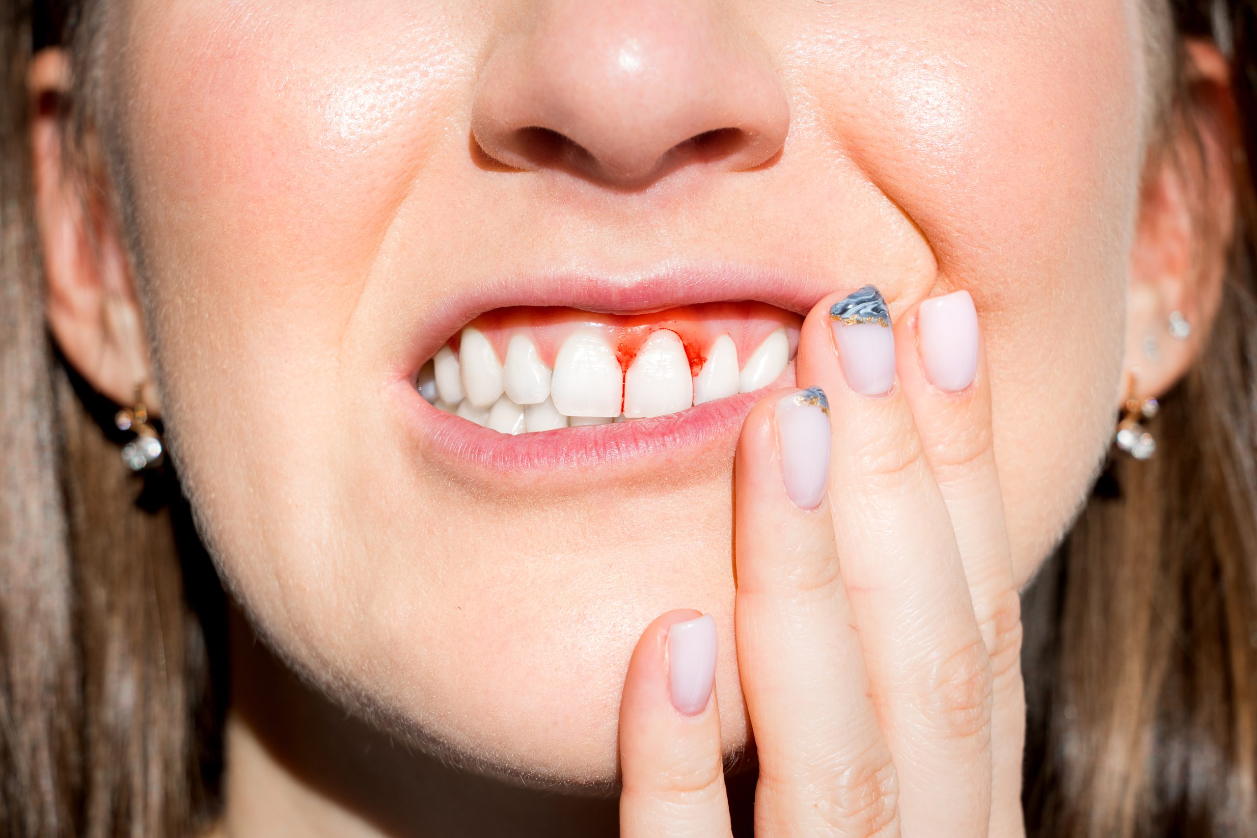Periodontal Surgery Allows us to Access Deep Surfaces for Plaque Removal