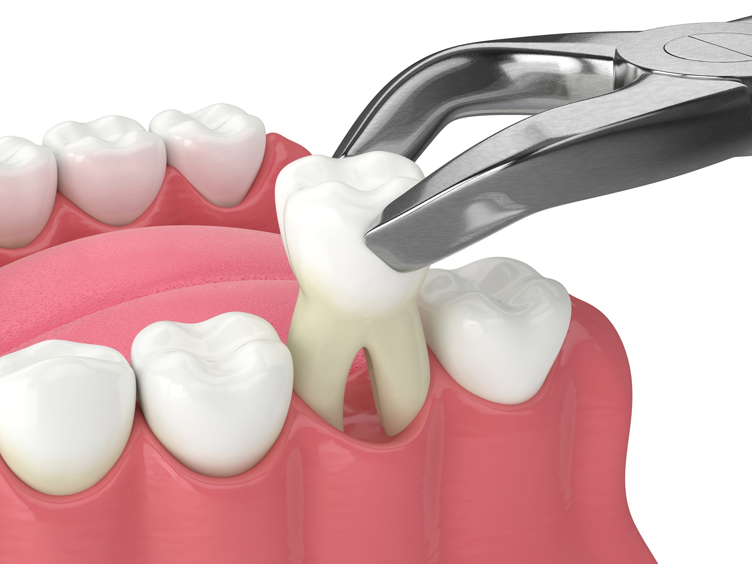 Removing Teeth Could Aid Orthodontic Treatment